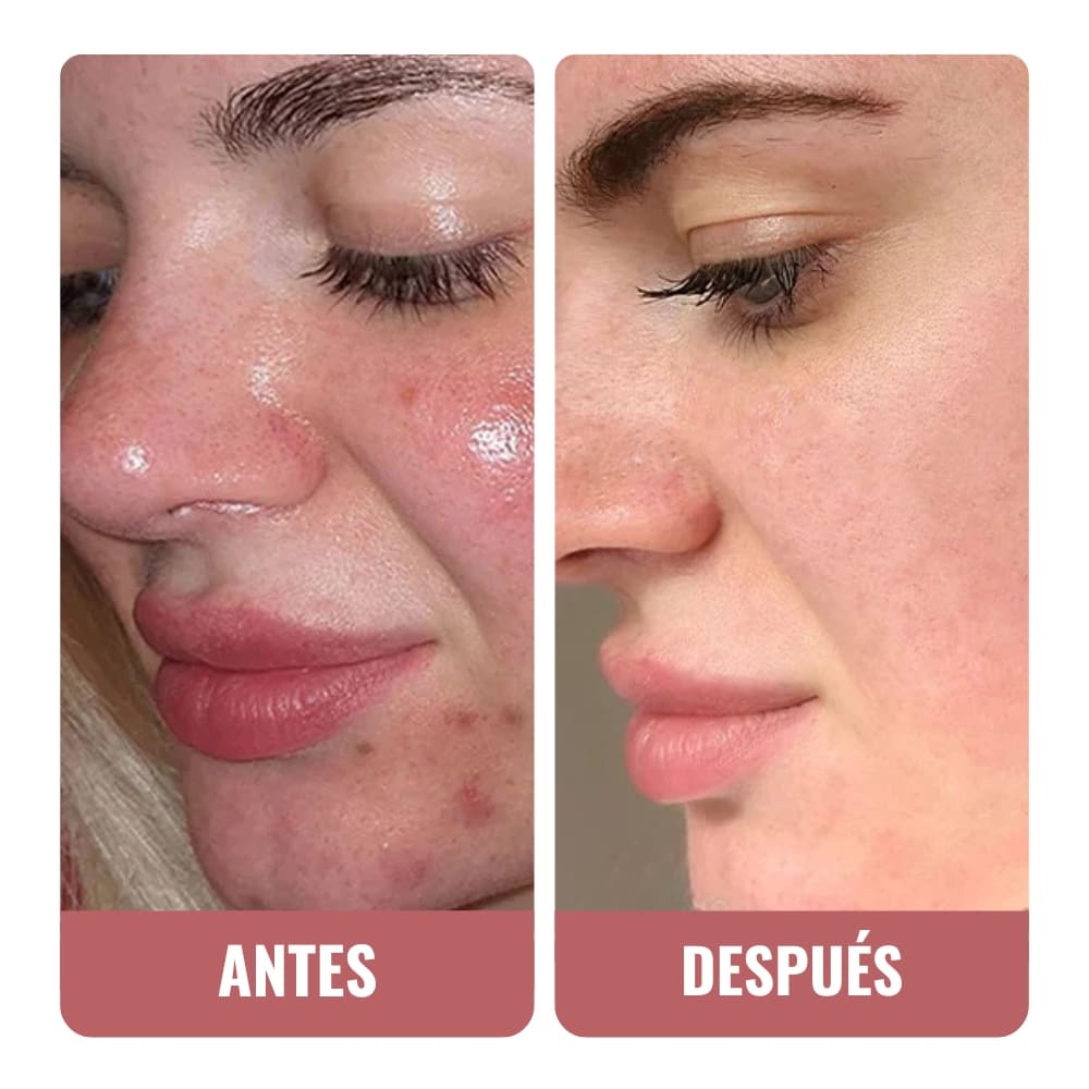 Mi salvación después de los brotes de acné